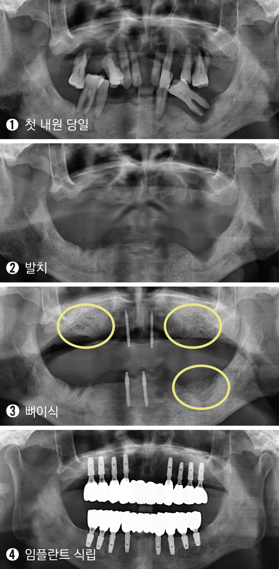치아 임플란트 치료 과정