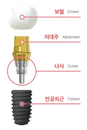 치과 임플란트 구조